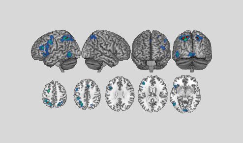 El síndrome moderno de la amígdala hiper-estimulada.